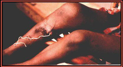 guinea worm